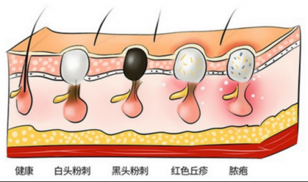 黑頭儀有用嗎？這么多款去黑頭的方法就屬它最有效