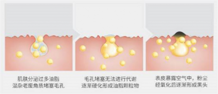 擺脫黑頭困擾，黑頭儀有用嗎？