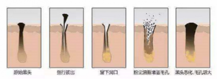 擺脫黑頭困擾，黑頭儀有用嗎？