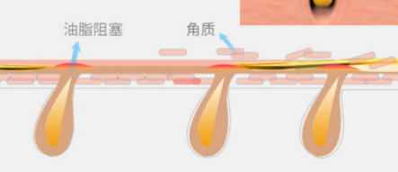 一百種去黑頭的方法都失敗了？去黑頭攻略全部拿下！