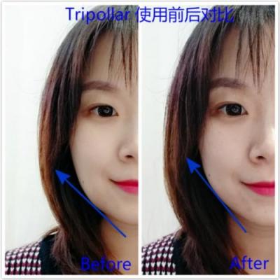 雅萌、GEVILAN歌嵐、Tripollar、NEWA美容儀到底選哪個？先評測一下再說
