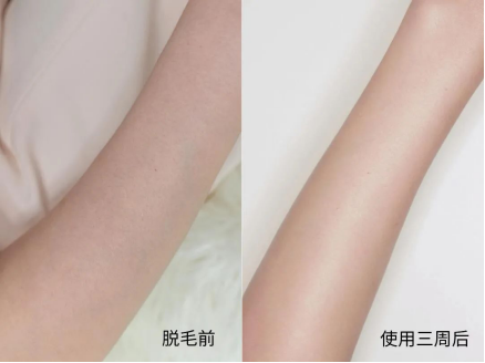 Ulike藍寶石脫毛儀：打開無痛脫毛新世界大門
