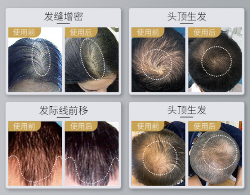 小米眾籌銷量驚人的可思美激光生發(fā)帽，真的能生發(fā)嗎？