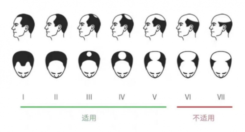 小米眾籌銷量驚人的可思美激光生發(fā)帽，真的能生發(fā)嗎？