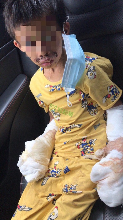 生命接力！輕松籌上愛心匯聚，幫助被生父燒傷的可憐男童重獲新生