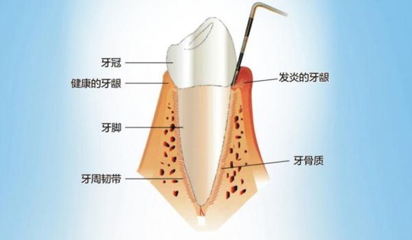 牙縫變大、總?cè)溃琛把乐懿　?/></p><p><strong>牙周病發(fā)病隱匿，早期一般無癥狀</strong></p><p>李永劍院長介紹，牙周病是指發(fā)生在牙周組織的疾病，包括牙齦組織的牙齦病和波及深層牙周組織(牙周膜、牙槽骨、牙骨質(zhì))的牙周炎兩大類。牙周疾病是常見的口腔疾病，也是引起成年人牙齒喪失的首要原因。</p><p>“牙周病與齲齒不同，它起病隱匿，初期不會疼痛，早期僅有出血等輕微癥狀，且病程長，可達(dá)數(shù)年之久，因此很容易被忽視。” 李永劍院長表示，牙周病的早期癥狀是刷牙和咬硬物出血，如果在這個階段進行積極治療，效果好，花費少。如果等到出現(xiàn)疼痛、腫脹、牙齒松動、脫落或咀嚼功能障礙時，已錯過最佳治療時機，不僅治療難度加大，治療費用增加，而且無法恢復(fù)到原來的健康水平。</p><p align=