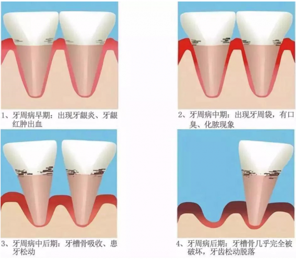 牙縫變大、總?cè)溃琛把乐懿　?/></p><p>同時，牙周炎會在不知不覺中使牙周組織遭到嚴(yán)重破壞，以致嚴(yán)重松動牙齒不得不被拔除。就好比一棵大樹，牙根就像樹根，而牙齒周圍的組織，如牙齦、牙周膜、牙槽骨等就像樹根周圍的泥土。如果樹根周圍的泥土沒了，那么即使大樹沒有被蟲蛀，也會倒掉。同理，如果牙根周圍的牙齦發(fā)炎、牙槽骨破壞到一定程度，即使牙齒沒有爛也沒辦法保留。</p><p>據(jù)了解，根據(jù)第 4 次全國口腔健康流行病學(xué)的調(diào)查，國人牙齒出血率為 87.4%，牙結(jié)石檢出率 96.7%，嚴(yán)重牙周炎的檢出率為 52.7%。也就是說，平均 10 個人中 9 個有牙周病，5 個有比較重的牙周炎。</p><p><strong>那么，牙周病是如何形成的?</strong></p><p>李永劍院長介紹，牙周炎的主要致病因子是牙菌斑，細(xì)菌及其產(chǎn)生的大量毒素刺激牙齦發(fā)炎，如果在這個階段進行積極治療可以完全恢復(fù)牙周健康。相反如果牙齦炎癥繼續(xù)發(fā)展，導(dǎo)致牙周袋形成和牙槽骨吸收，最終的結(jié)果就是牙齒松動和脫落。牙菌斑無法通過漱口或者藥物去除，最好的辦法是機械清除，一是正確的刷牙，輔助使用牙線、牙縫刷;二是由專業(yè)的口腔醫(yī)生進行專業(yè)維護，控制牙菌斑。</p><p align=