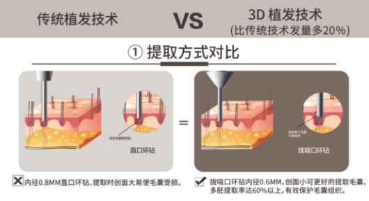 女性植發(fā)消費(fèi)崛起，武漢新生植發(fā)3D植發(fā)高性價(jià)比受歡迎