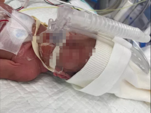 孩子剛出生就住進ICU，水滴籌筑起生命長城